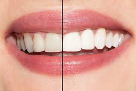 Tips for Teeth Whitening