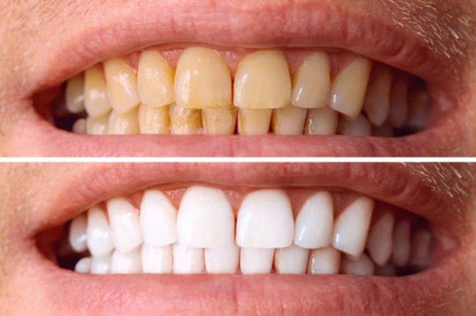 Teeth Whitening Treatment in Mohali