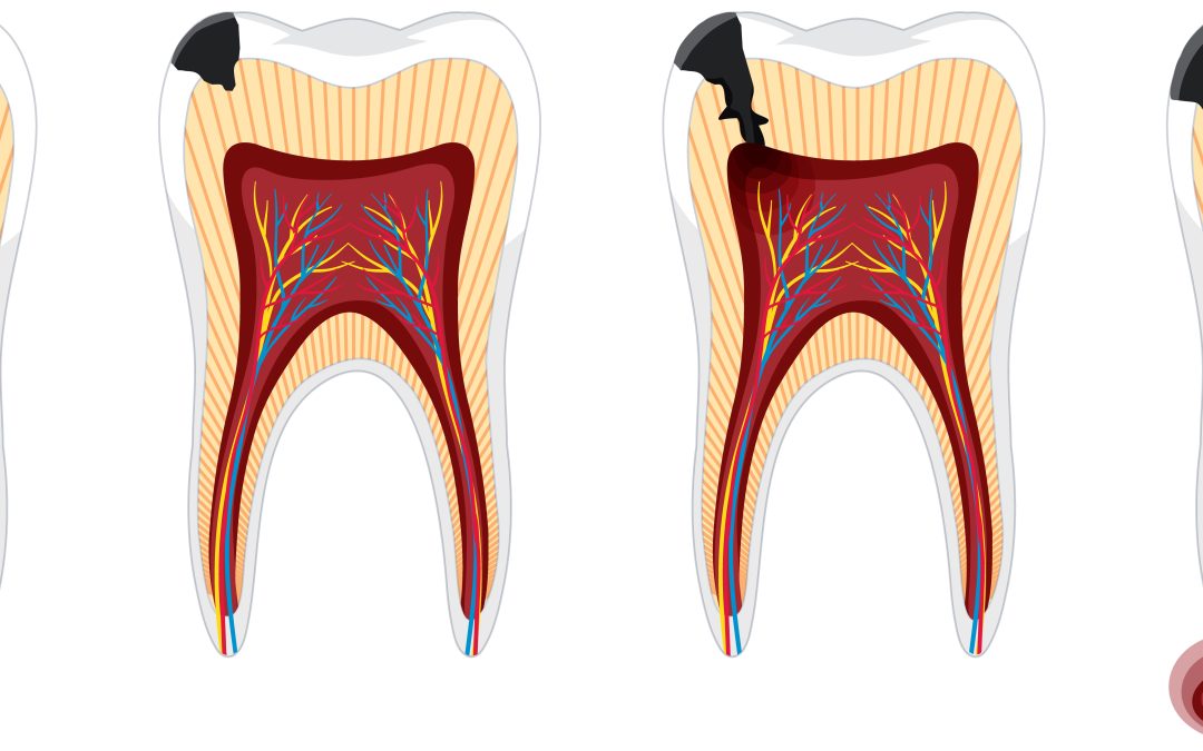 Understanding Root Canal Treatment: A Comprehensive Guide